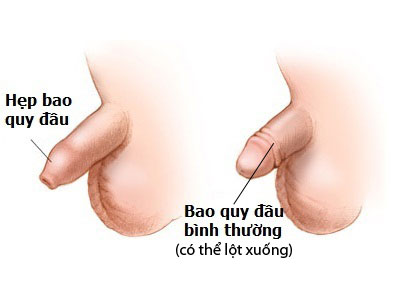 Hep bao quy dau