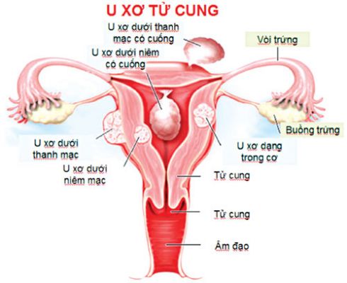 u xơ tử cung có nguy hiểm không