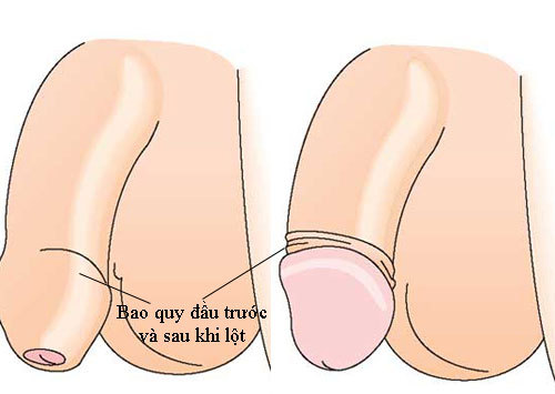 Bao quy đầu là gì, các bệnh lý liên quan đến bao quy đầu