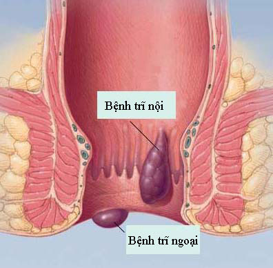 benh tri ngoai