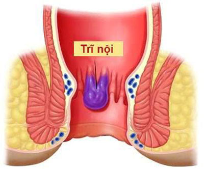 benh tri noi