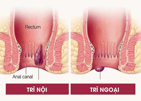 bệnh trĩ là gì