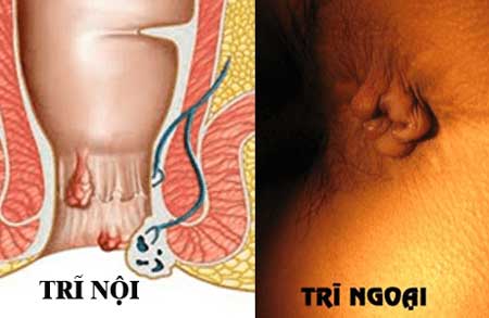 dấu hiệu bệnh trĩ