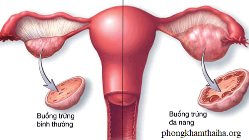 Buồng trứng đa nang