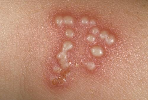 Herpes sinh dục