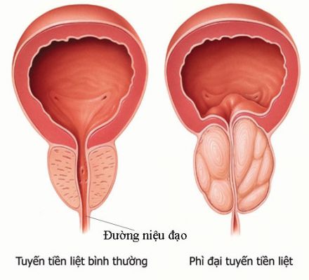 Phì đại tuyến tiền liệt