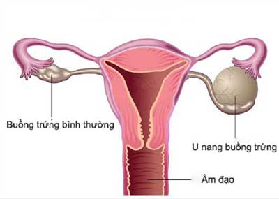 u nang buồng trứng