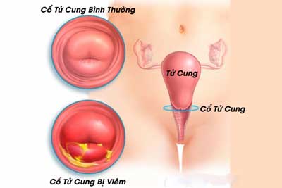viêm cổ tử cung