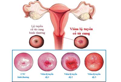 viêm lộ tuyến cổ tử cung