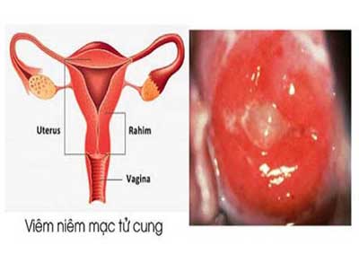 viêm nội mạc tử cung
