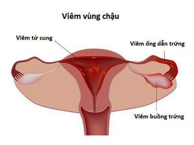 viêm vùng chậu