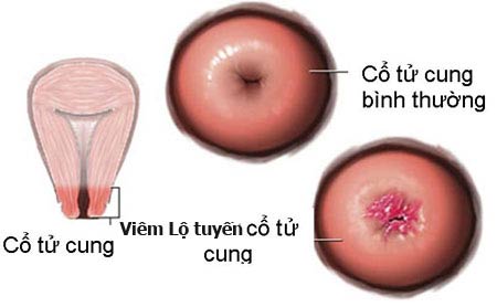 trieu chung viem lo tuyen co tu cung
