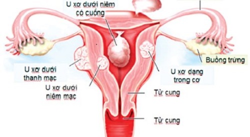 u xơ tử cung