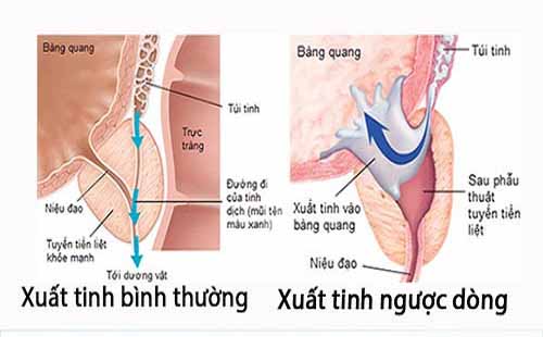 xuất tinh ngược dòng
